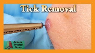 Dead Tick Removal  Auburn Medical Group [upl. by Perot]