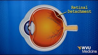 Karens Story Retinal Detachment [upl. by Yenahc]