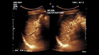 Splenic Calcifications  Ultrasound  Case 10 [upl. by Niggem]