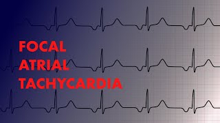 Focal Atrial Tachycardia  EKG Interpretation  MEDZCOOL [upl. by Dygal]