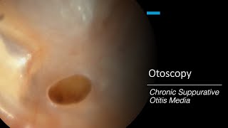 Chronic Suppurative Otitis Media Otoscopy [upl. by Ahtael]