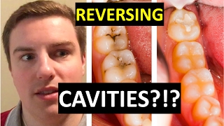 CAN YOU CURE CAVITIES AT HOME [upl. by Nika564]