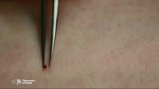 Proper Tick Removal [upl. by Acireed]