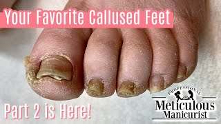 Extremely Callused Feet How to Pedicure  Left Foot [upl. by Anilrats]