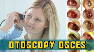 OTOSCOPY OSCEs  PLAB Image Reference [upl. by Wye374]