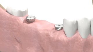 SIC invent Dental Implant  Prosthetic Animation BridgeWork Open Tray Technique [upl. by Casar]