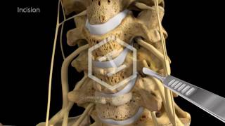 c5c6c7 Anterior Cervical Discectomy with Fusion [upl. by Eveineg]