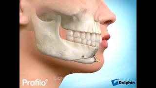 Chin Augmentation Surgery Genioplasty [upl. by Zeiler]