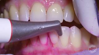 How teeth should be cleaned at the Dentist  Hygienist [upl. by Neelhtakyram]