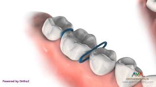 Orthodontic Separator or Spacer  Rubber ORings [upl. by Zeus]