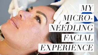 My Microneedling Facial Experience [upl. by Calie]