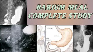 Barium Meal Complete Study Of Stomach [upl. by Kcira186]