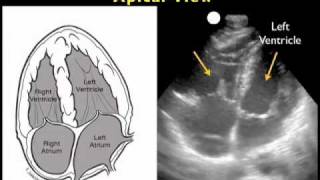 How to Cardiac Ultrasound  Apical View Case Study [upl. by Abbotsun646]