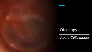 Acute Otitis Media Otoscopy [upl. by Toddy]