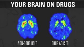 How addiction changes your brain [upl. by Covell61]