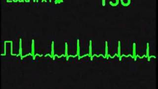 Atrial Fibrillation  AFIB  ECG Simulator  Arrhythmia Simulator [upl. by Tootsie563]