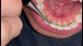 “POST BRACES” Fixing Bonded Retainer [upl. by Fairbanks]