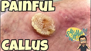 SATISFYING CALLUS REMOVAL FROM FEET [upl. by Asil]