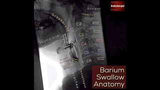 Barium Swallow and Modified Barium Swallow Cine [upl. by Aramac]