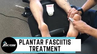 Plantar Fasciitis Treatment San Diego Graston Chiropractic [upl. by Saleme702]