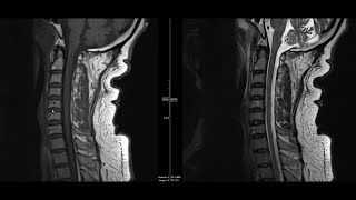 Noncontrast MRI cervical spine search pattern [upl. by Aiz]