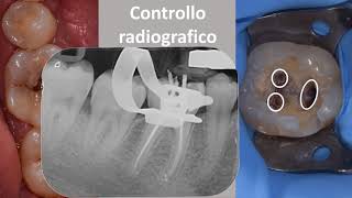 Devitalizzazione di un dente molare [upl. by Cawley385]