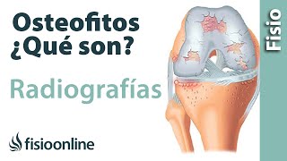 Osteofitos  Qué son y cómo se ven en radiografías y TAC [upl. by Stretch]