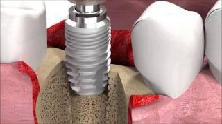 SIC invent Dental Implant Procedure SICmax implant insertion [upl. by Ennael]