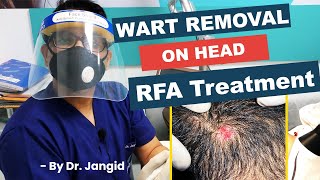 Wart Removal on Head  Live RFA Wart Removal Treatment  Dr Jangid [upl. by Ancilin515]