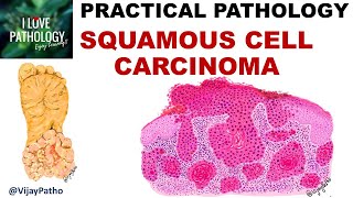 SQUAMOUS CELL CARCINOMA Clinical features amp Morphology Premalignant lesions [upl. by Sile]