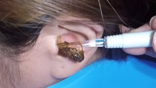 The Most Massive Earwax Removed in One Scoop [upl. by Savory]