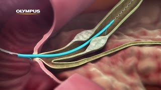 QuickPlaceV Biliary Stent [upl. by Dagny]