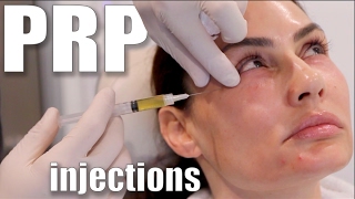 PRP Injections to Face and Neck Blood Facial [upl. by Ogires]