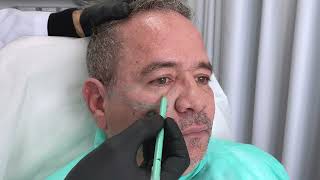 Acido Hialuronico Facial Region Periorbitaria Malar y Tercio Medio por Dr Martin Gaston Alvarez [upl. by Inaluahek]