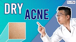 How To Treat Dry Skin  Acne Dry Acne  5 Tips To Follow [upl. by Palua]