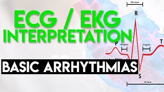 Basic Arrhythmias  Sinus Brady Tachy Premature Beats  ECG EKG Interpretation Part 3 [upl. by Debor]