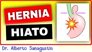 HERNIA DE HIATO 💥 Causas Síntomas Clasificación y Tratamiento [upl. by Linnette]