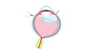 Instructions After Vitrectomy Surgery [upl. by Nuahsyd237]