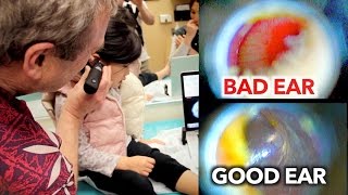 EAR INFECTION vs PERFECT EAR Inside Look  Dr Paul [upl. by Taggart]