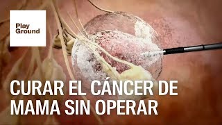 Cáncer de mama descubren cómo curarlo sin cirugía [upl. by Willdon]