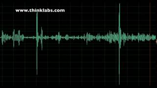 Innocent Systolic Murmur [upl. by Halilad]