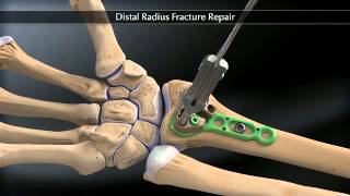 Arthrex Distal Radius Fracture Fixation [upl. by Osborne]