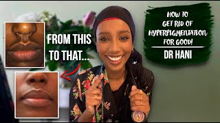 How To Get Rid Of Hyperpigmentation  Dr Hani [upl. by Uel]