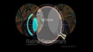 Retinal Detachment [upl. by Dincolo]