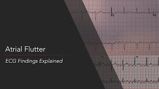 Atrial Flutter ECG Findings Explained [upl. by Glovsky864]