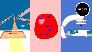 The HighDose Rate HDR Brachytherapy Procedure to Treat Cancer [upl. by Owain]