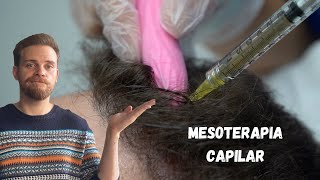 ¿FUNCIONA LA MESOTERAPIA CAPILAR [upl. by Irb]