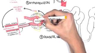 Chronic Kidney Disease CKD Pathophysiology [upl. by Nehte775]