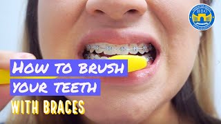 How to Brush with Braces  3 Brushing Tips [upl. by Myrtia]