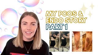 My PCOS and Endometriosis Story Part 2 [upl. by Adiell188]